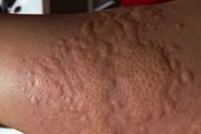 Skin Hardening can lead to Kidney Failure